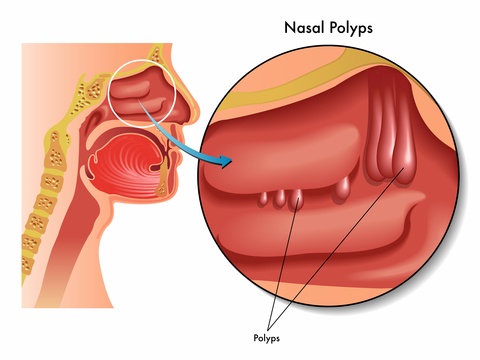 Nasal Polyp Treatment at Raj ENT Hospital Jaipur