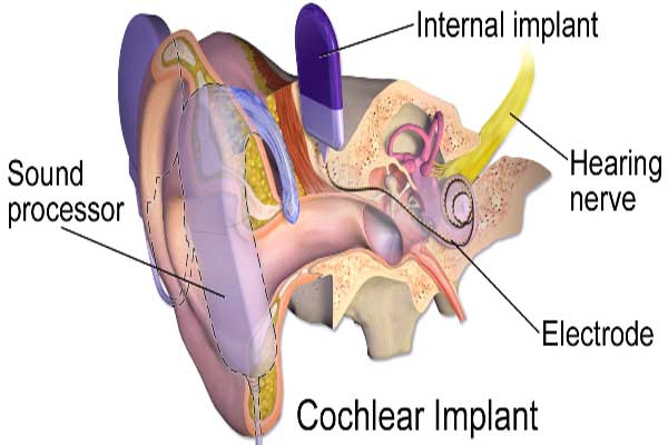 Cochlear Implant