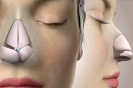 Rhinoplasty