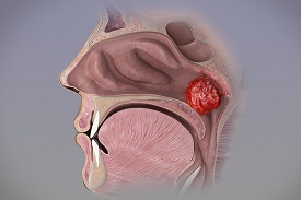 Adenoids Treatment