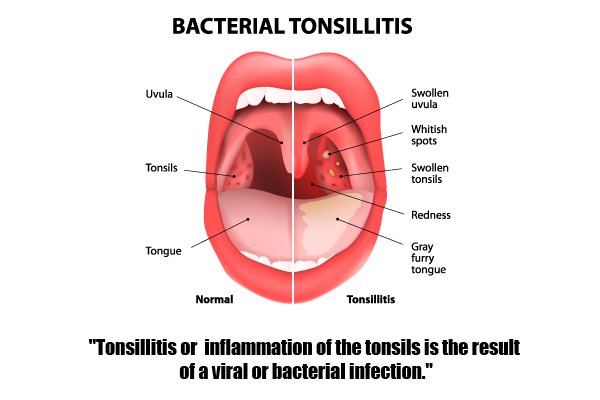 Tonsillitis