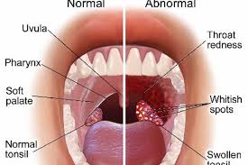 Voice Surgeries